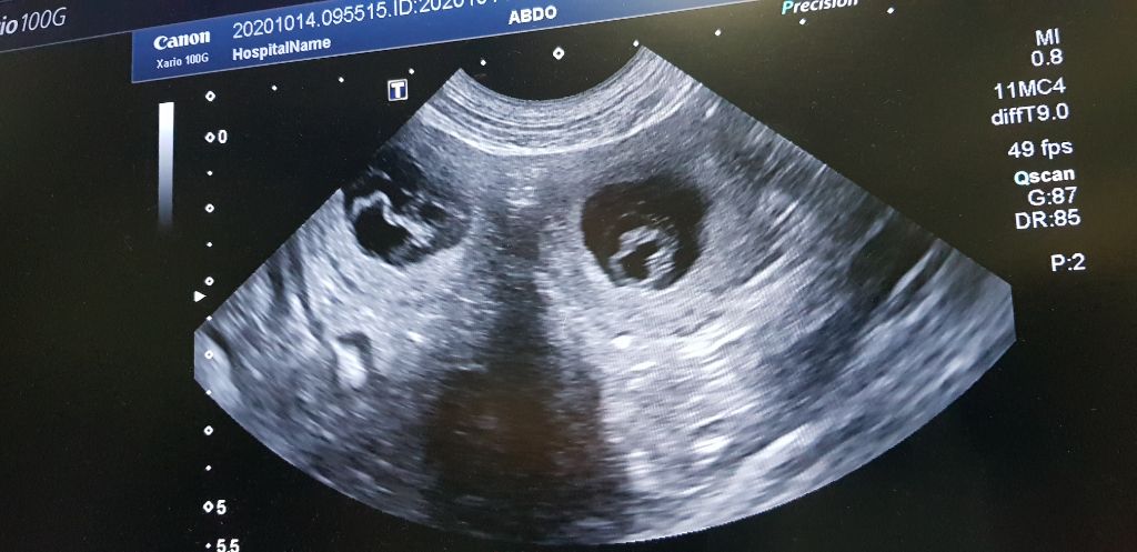 du Val de Méouge - Echographie positive Ounénet attend bien des bébés ce 14/10/2020